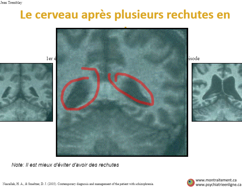 Exemple d'une atteinte du cerveau suite à plusieurs épisodes de psychose
